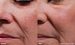 Revitalize Your Skin | Pixel Rejuvenation | South Denver OB-GYN